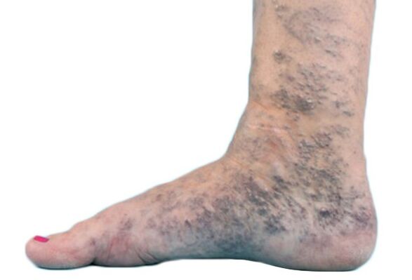 Varices sur les jambes