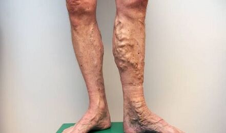 varices chez les hommes