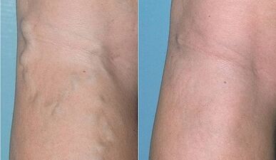 Comment traiter les varices sur les jambes