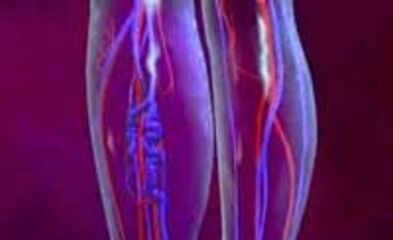 Causes et traitement des varices