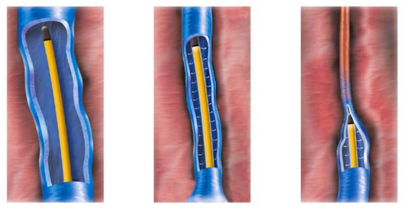 ablation par radiofréquence comme méthode de traitement des varices